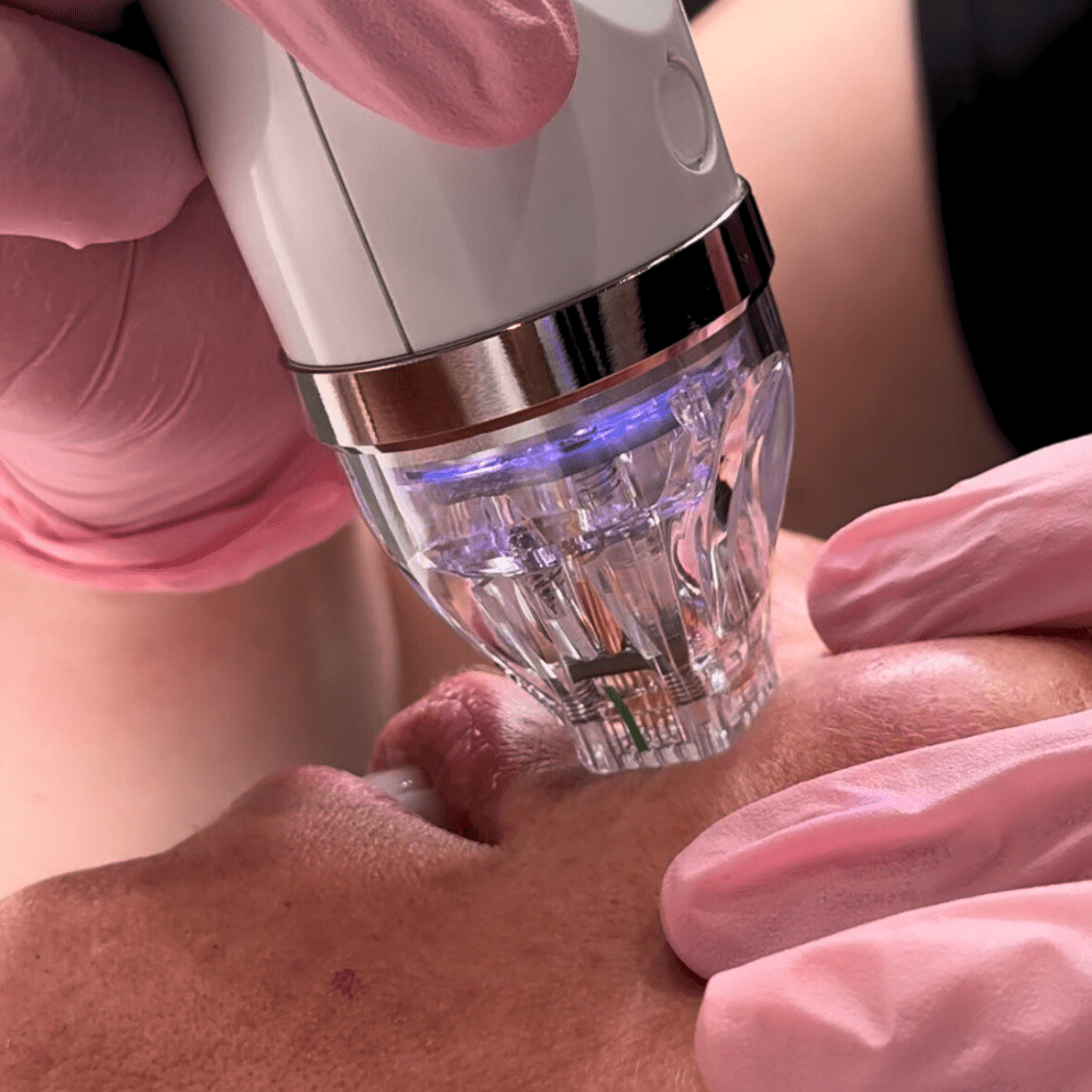 10 Benefits of Secret RF Microneedling — And Why Your Skin Will Thank You