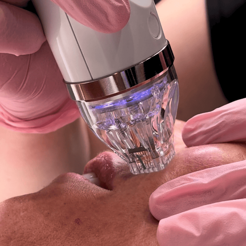 10 Benefits of Secret RF Microneedling — And Why Your Skin Will Thank You