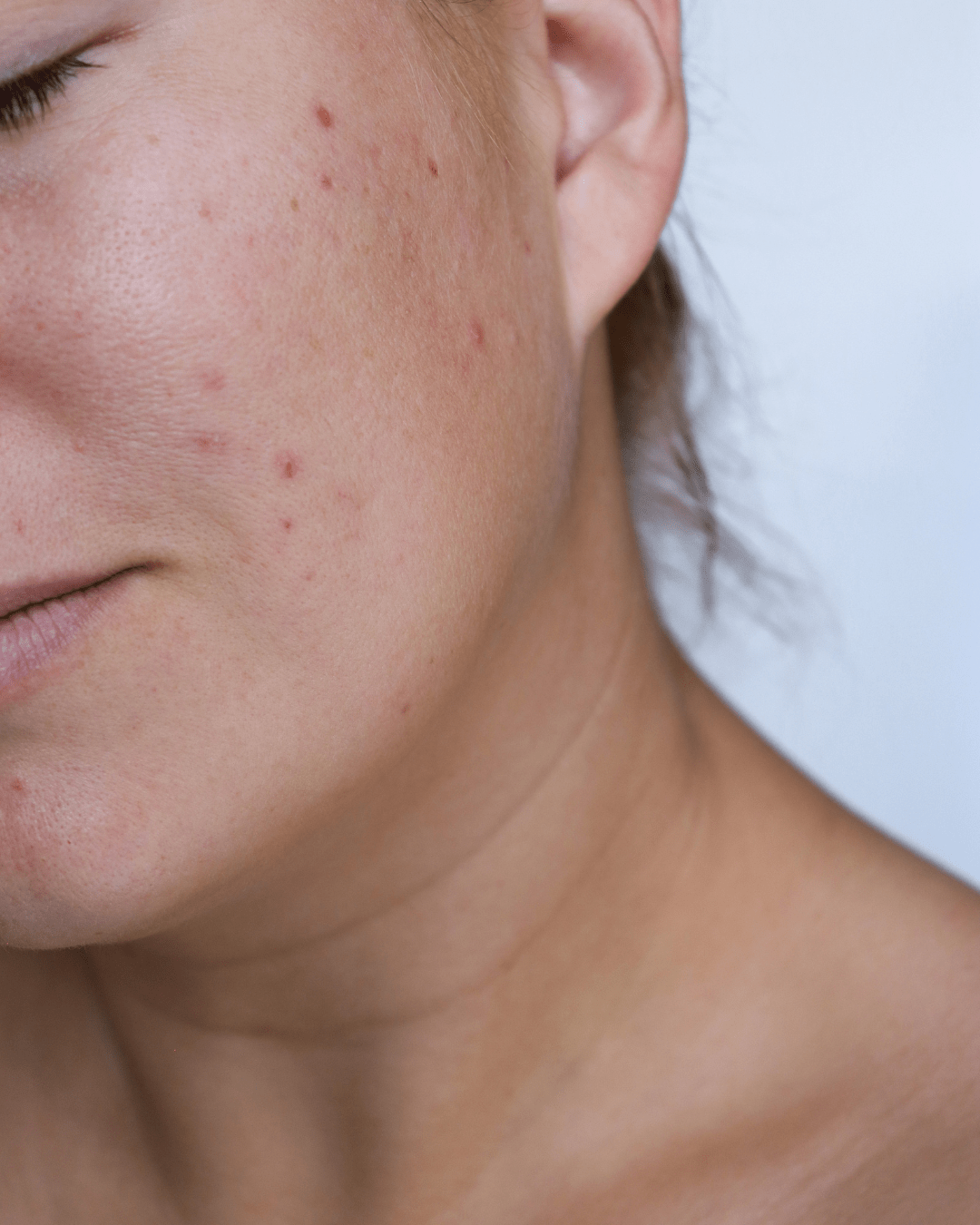Acne Awareness Month